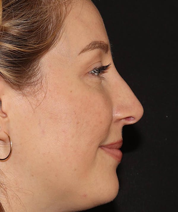Liquid Rhinoplasty Before & After Gallery - Patient 405617 - Image 2