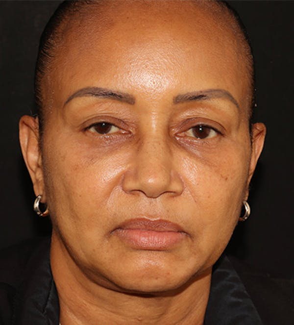Facetite Before & After Gallery - Patient 283696 - Image 1
