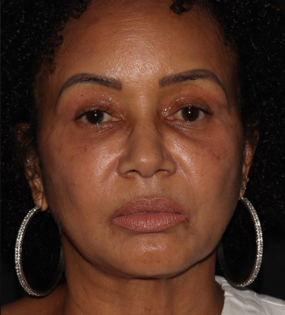 Facetite Before & After Photos | Yael Halaas MD