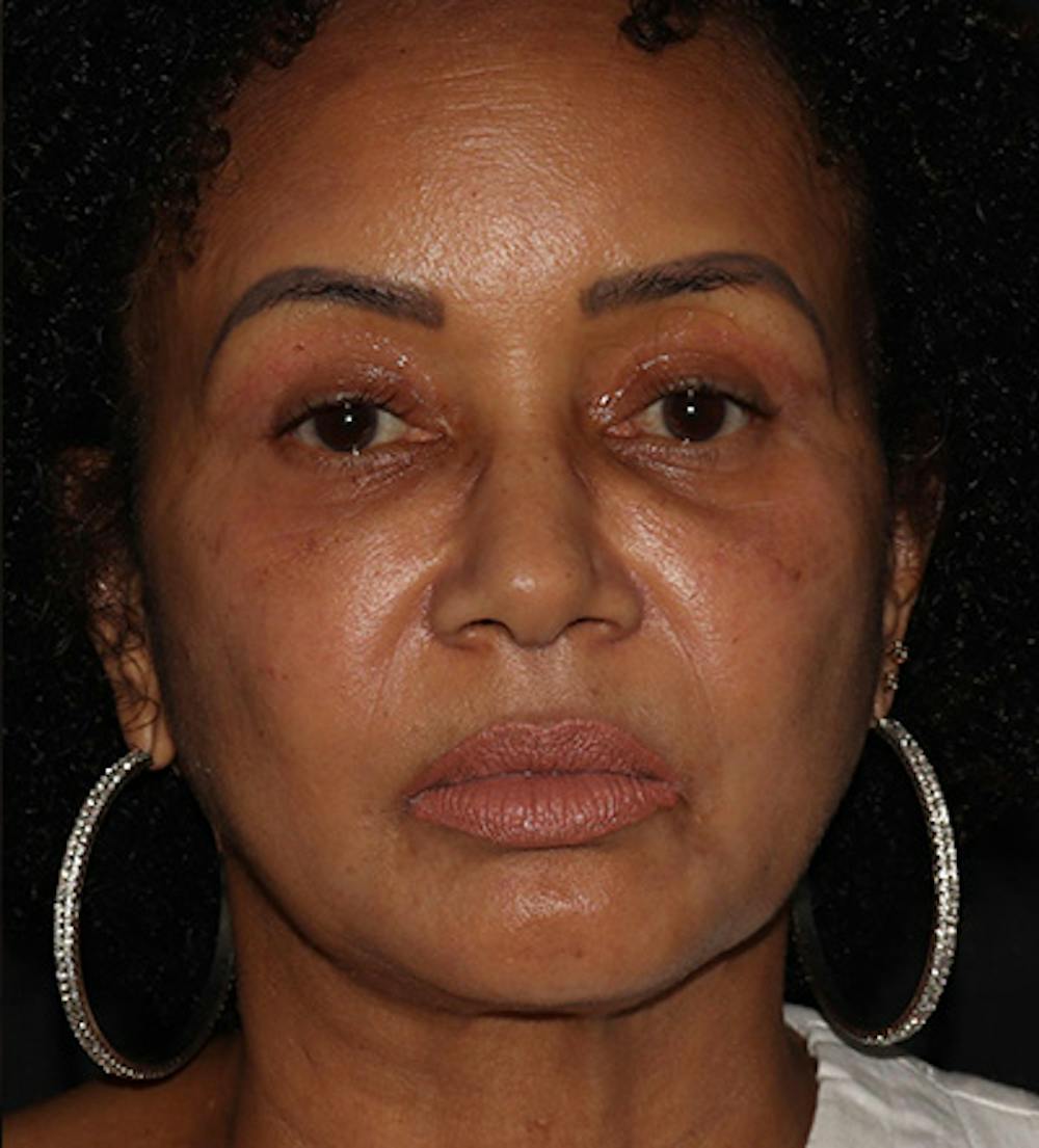 Facetite Before & After Gallery - Patient 283696 - Image 2