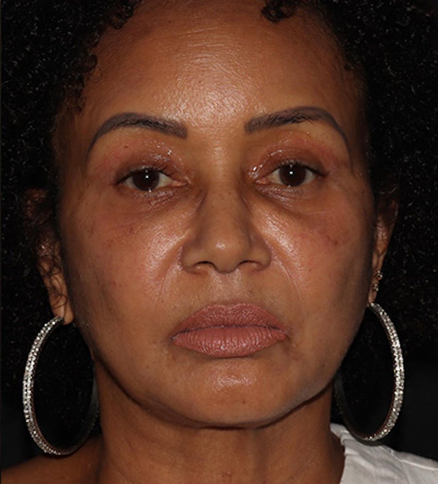 Facetite Before & After Gallery - Patient 283696 - Image 2