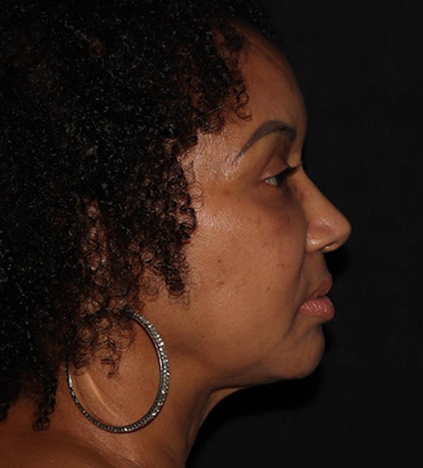 Facetite Before & After Gallery - Patient 283696 - Image 4