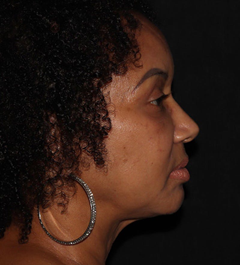 Facetite Before & After Gallery - Patient 283696 - Image 4