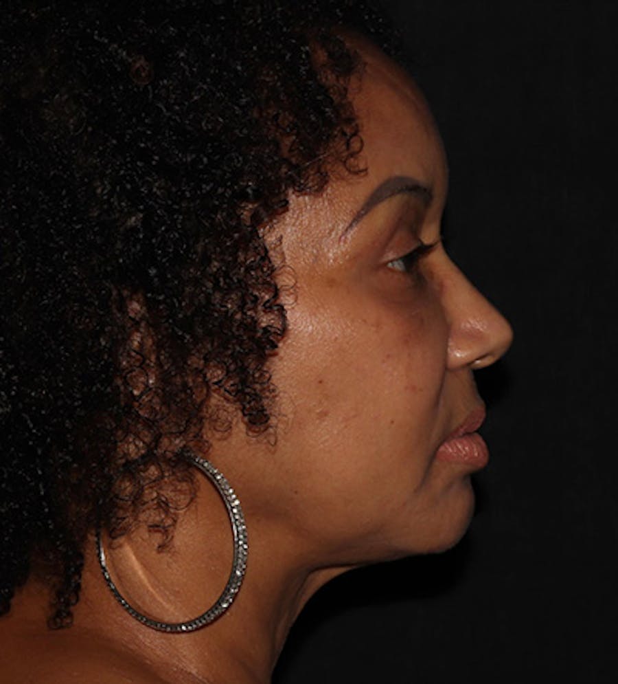 Facetite Before & After Gallery - Patient 283696 - Image 4