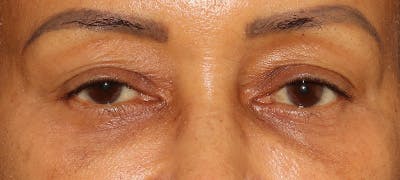  Blepharoplasty Before & After Gallery - Patient 746491 - Image 1