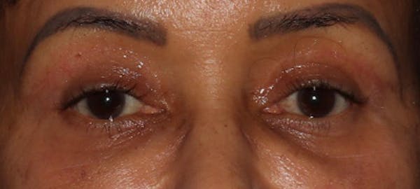  Blepharoplasty Before & After Gallery - Patient 746491 - Image 2