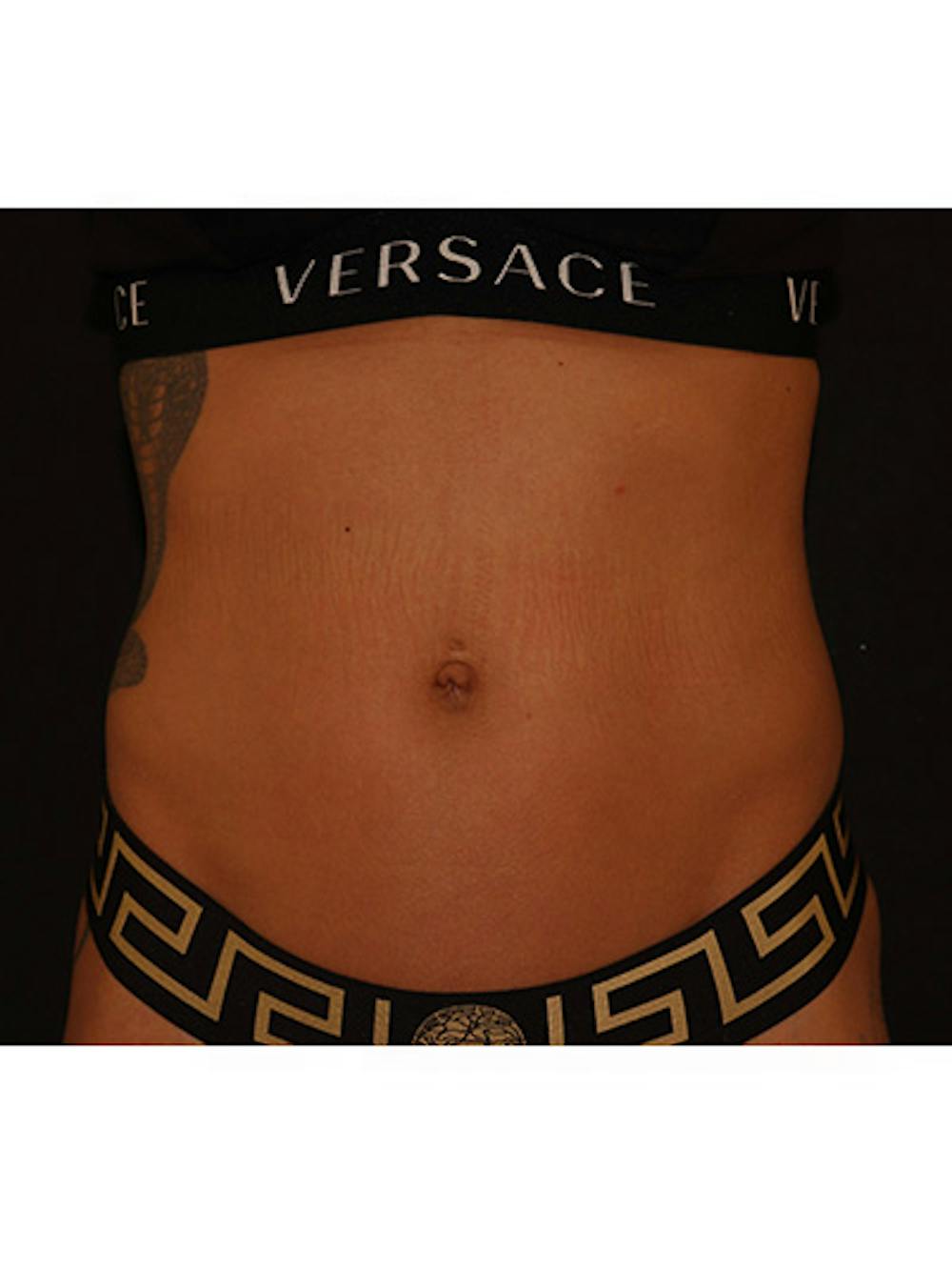 Emsculpt Neo Before & After Gallery - Patient 877249 - Image 5