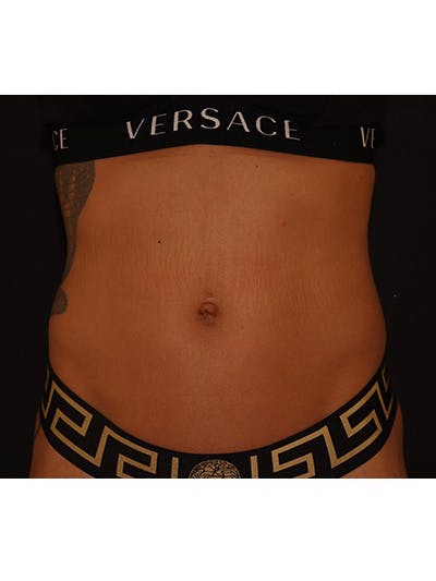 Emsculpt Neo Before & After Gallery - Patient 877249 - Image 5