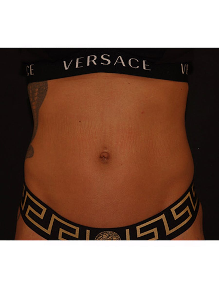 Emsculpt Neo Before & After Gallery - Patient 877249 - Image 5