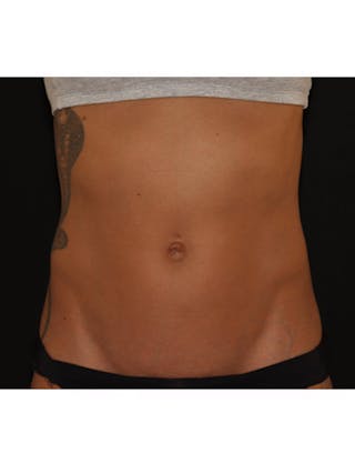 Emsculpt Neo Before & After Gallery - Patient 877249 - Image 6