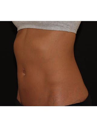 Emsculpt Neo Before & After Gallery - Patient 877249 - Image 4