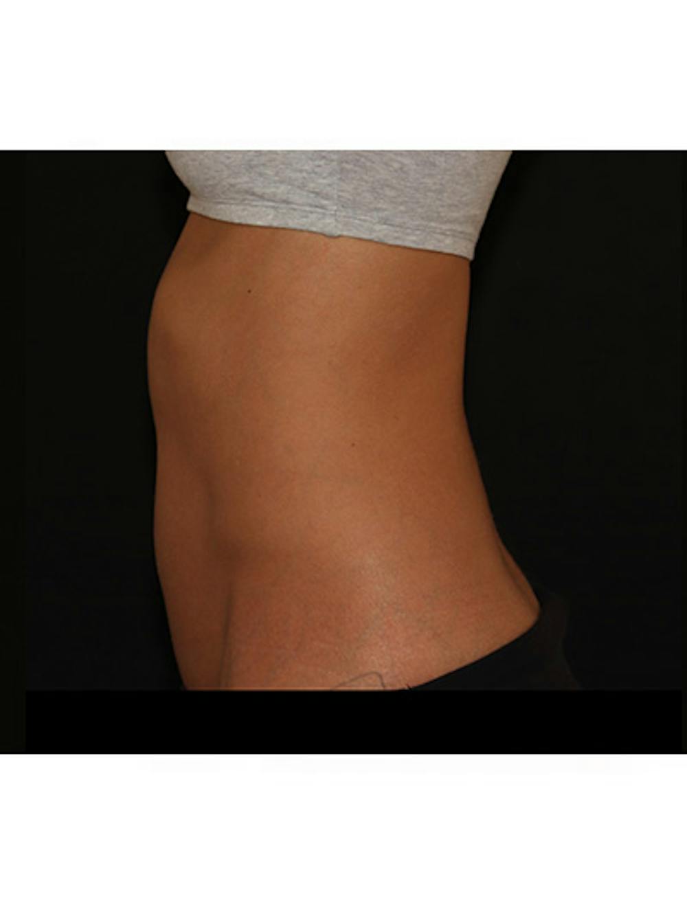 Emsculpt Neo Before & After Gallery - Patient 877249 - Image 2