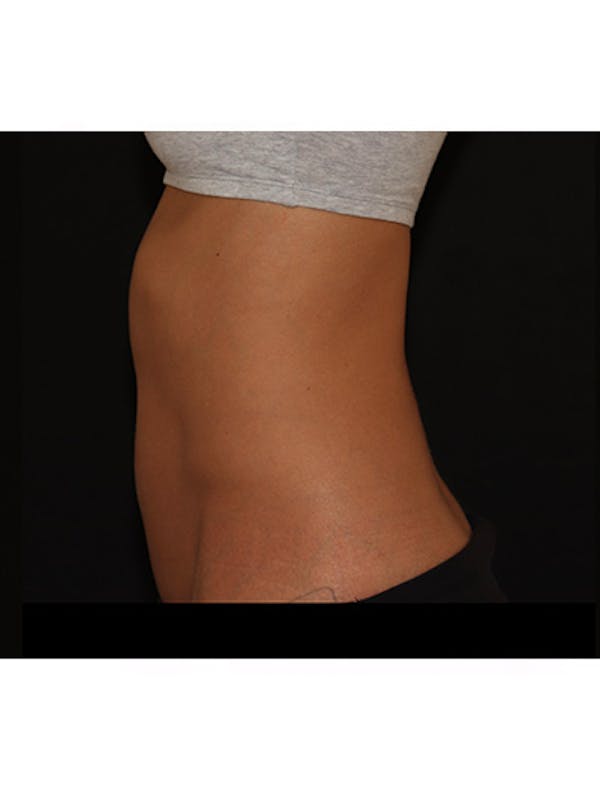 Emsculpt Neo Before & After Gallery - Patient 877249 - Image 2