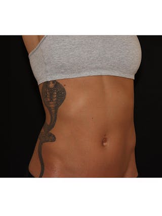 Emsculpt Neo Before & After Gallery - Patient 877249 - Image 8