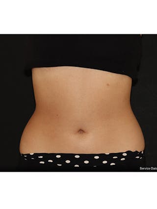 Emsculpt Neo Before & After Gallery - Patient 198612 - Image 4