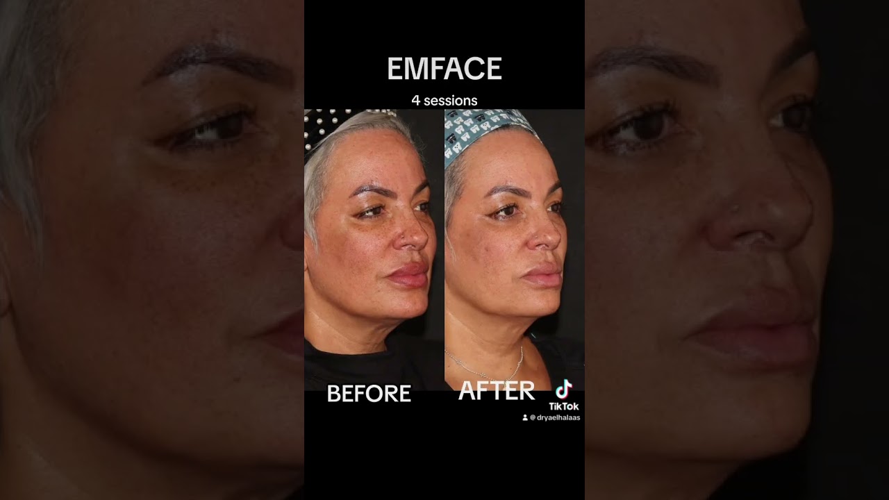 emface before and after