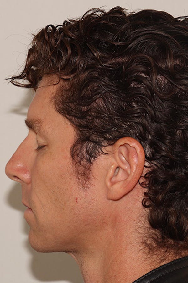 Jawline Filler Before & After Gallery - Patient 313146 - Image 5