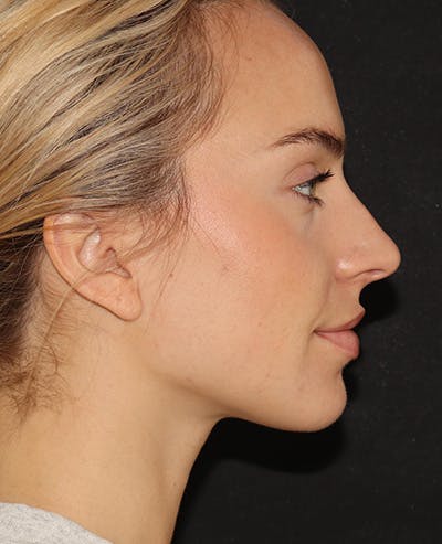 Botox Before & After Gallery - Patient 175663 - Image 4
