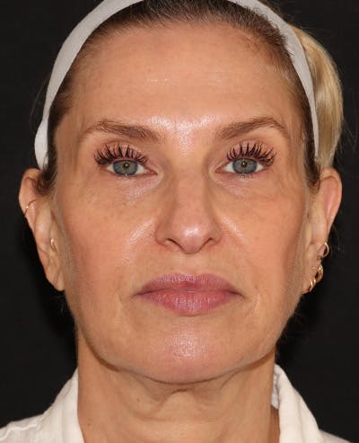 Facelift Before & After Gallery - Patient 319082 - Image 1