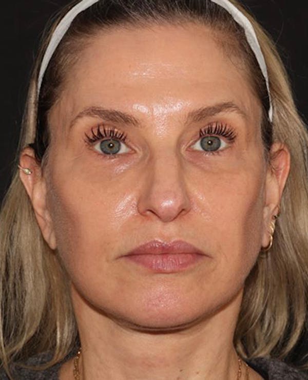 Facelift Before & After Gallery - Patient 319082 - Image 2