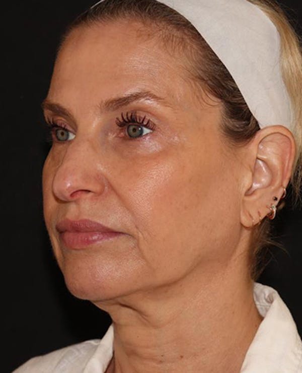 Facelift Before & After Gallery - Patient 319082 - Image 3