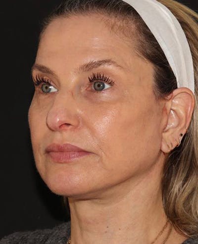 Facelift Before & After Gallery - Patient 319082 - Image 4