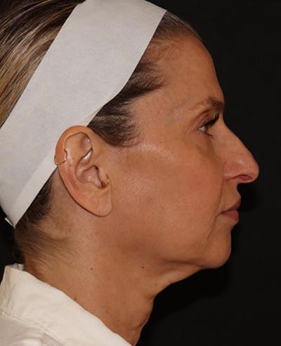 Facelift Before & After Gallery - Patient 319082 - Image 5