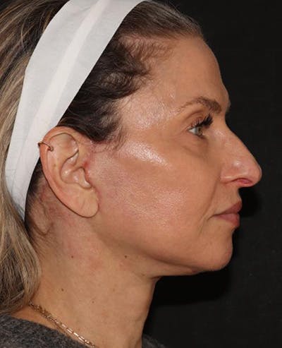 Facelift Before & After Gallery - Patient 319082 - Image 6