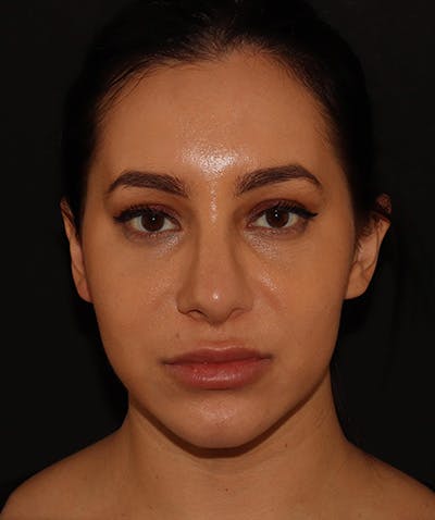 Silhouette Lift  Before & After Gallery - Patient 408491 - Image 3