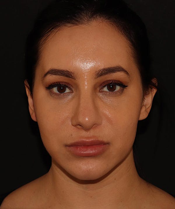 Silhouette Lift  Before & After Gallery - Patient 408491 - Image 3