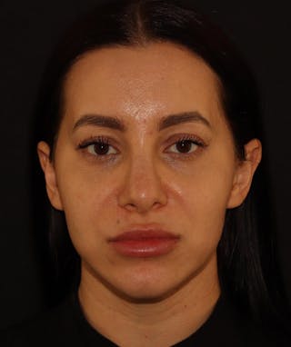 Silhouette Lift  Before & After Gallery - Patient 408491 - Image 4