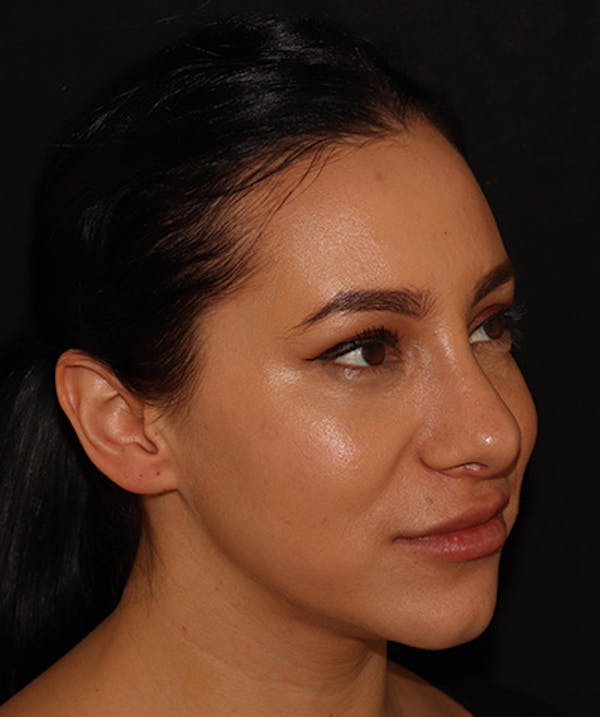 Silhouette Lift  Before & After Gallery - Patient 408491 - Image 1
