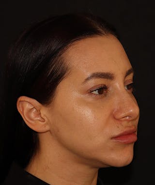 Silhouette Lift  Before & After Gallery - Patient 408491 - Image 2