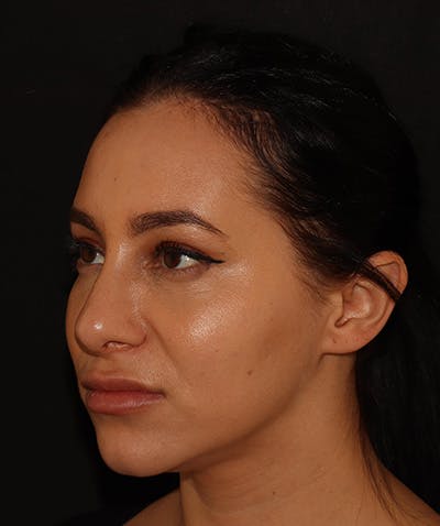 Silhouette Lift  Before & After Gallery - Patient 408491 - Image 5