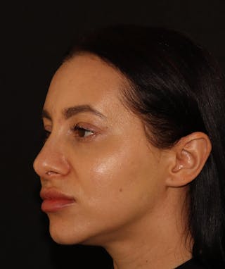 Silhouette Lift  Before & After Gallery - Patient 408491 - Image 6