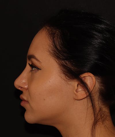 Silhouette Lift  Before & After Gallery - Patient 408491 - Image 7