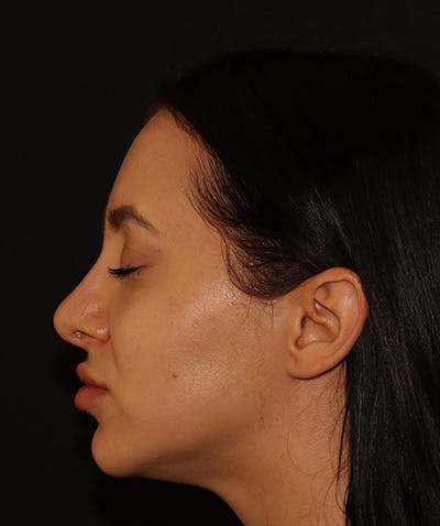 Silhouette Lift  Before & After Gallery - Patient 408491 - Image 8