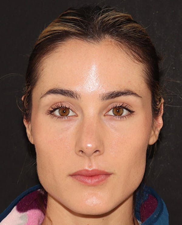 Botox Before & After Gallery - Patient 372579 - Image 1