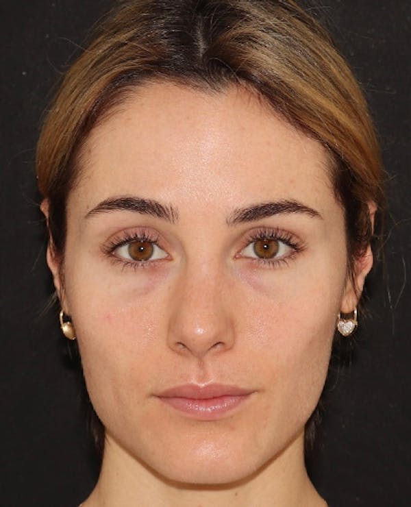 Botox Before & After Gallery - Patient 372579 - Image 2