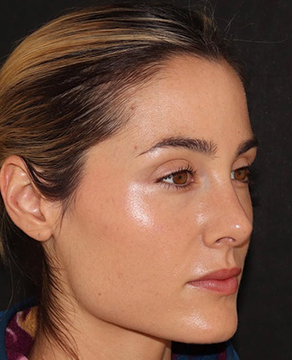 Botox Before & After Gallery - Patient 372579 - Image 3