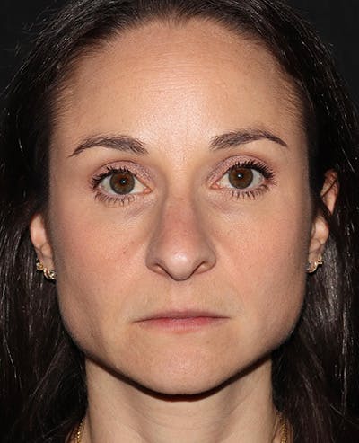 Botox Before & After Gallery - Patient 216624 - Image 1