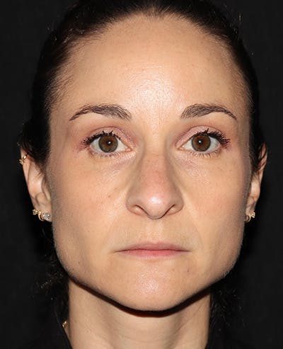 Botox Before & After Gallery - Patient 216624 - Image 2