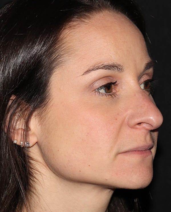 Botox Before & After Gallery - Patient 216624 - Image 3