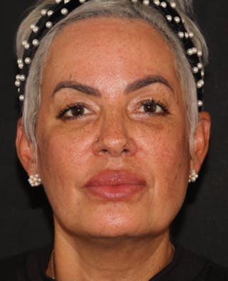 EMFACE Before & After Gallery - Patient 195867 - Image 2