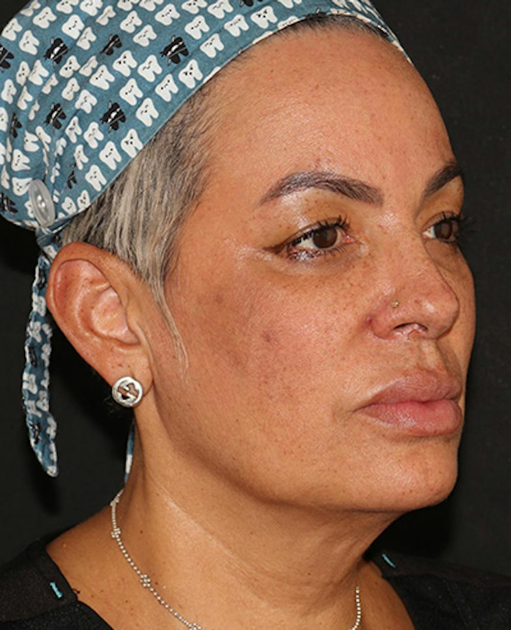 EMFACE Before & After Gallery - Patient 195867 - Image 3