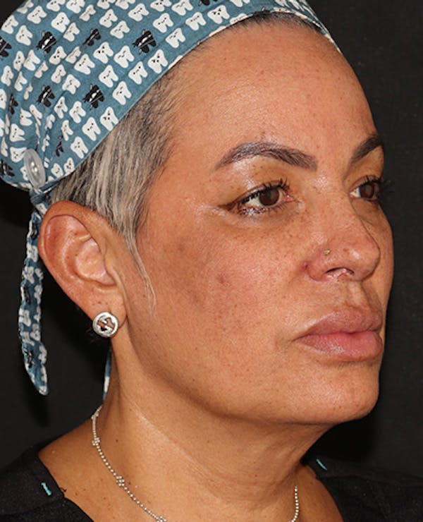 EMFACE Before & After Gallery - Patient 195867 - Image 3