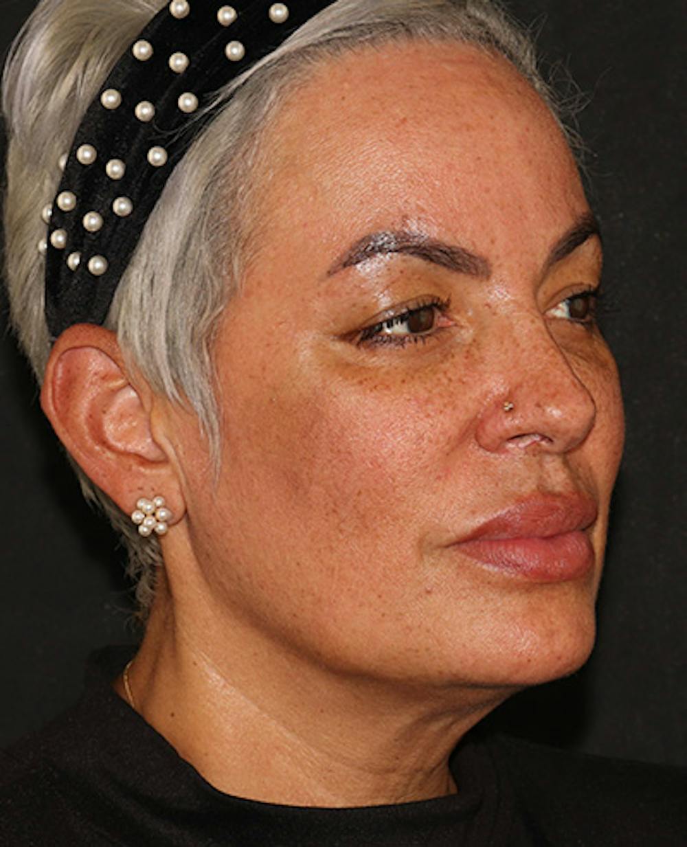 EMFACE Before & After Gallery - Patient 195867 - Image 4