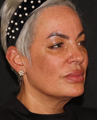 EMFACE Before & After Gallery - Patient 195867 - Image 4