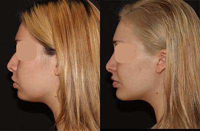 Chin Augmentation Before & After Gallery - Patient 268360 - Image 1