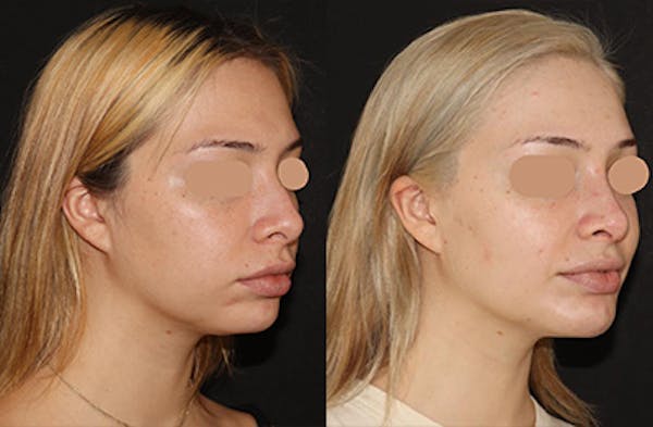 Chin Augmentation Before & After Gallery - Patient 268360 - Image 2
